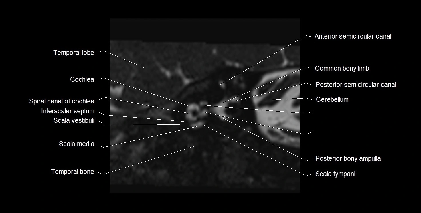 Internal auditory meatus (IAM) 3T sagittal cross sectional anatomy image 10.webp